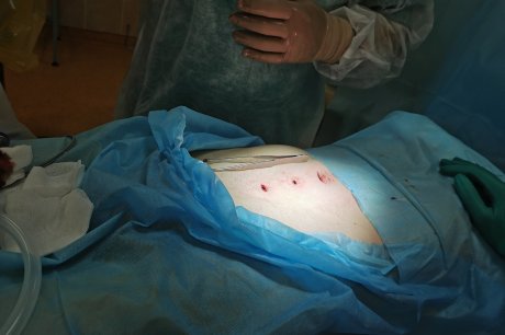 Операция по удалению паховой грыжи минск