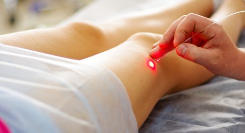 Снижена цена на эндовенозную лазерную коагуляцию 